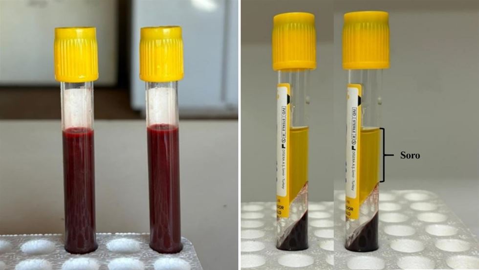 Sangue recentemente coletado (à esquerda) e após centrifugação (à direita).