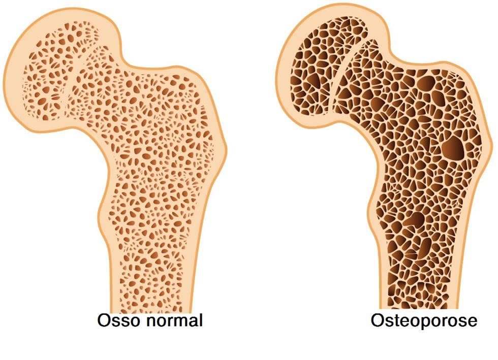osteoporose - ossos - leite 